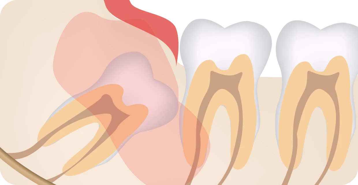 Extraction dentaire au Médical Smile, centres médico-dentaires Chartreux et Mazargues à Marseille